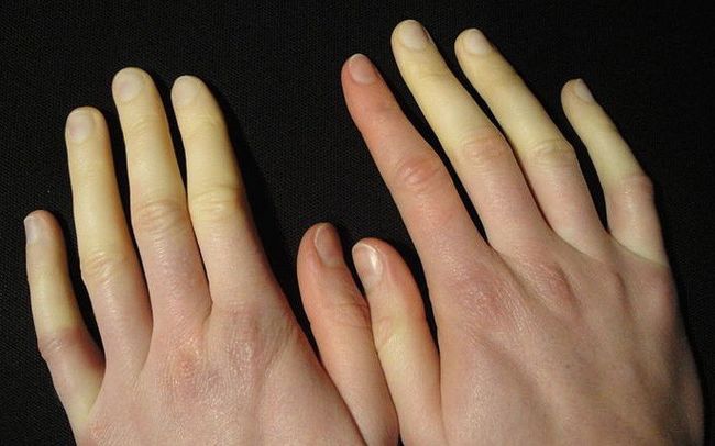 syndrome raynaud changement couleur mains blanche rouge